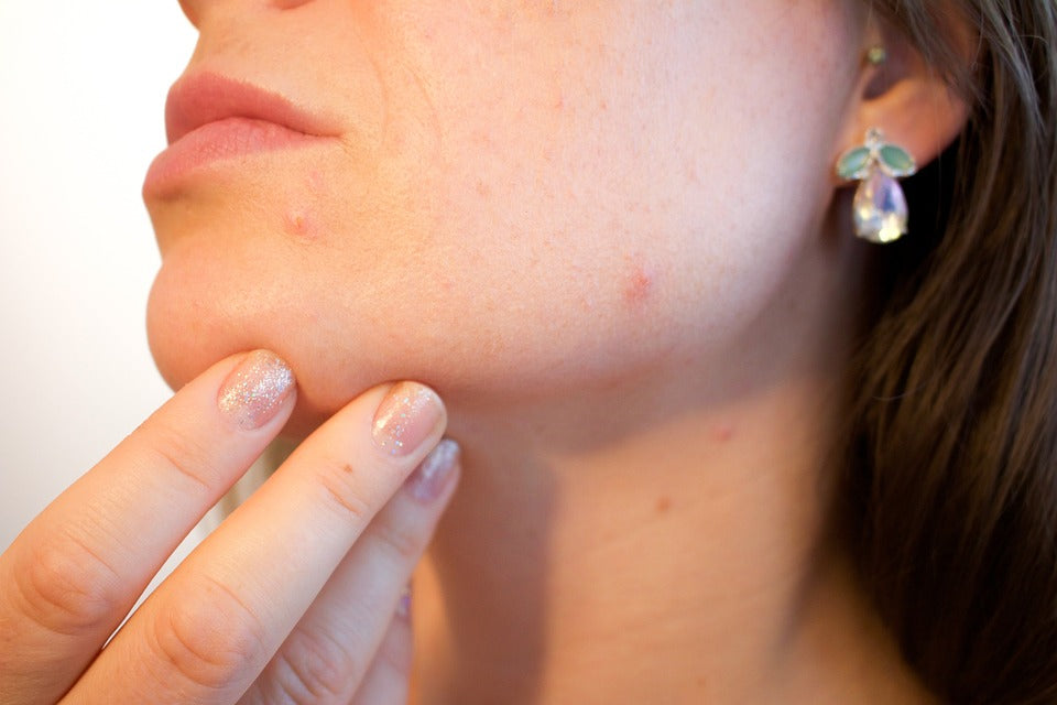 Acne & Breakouts