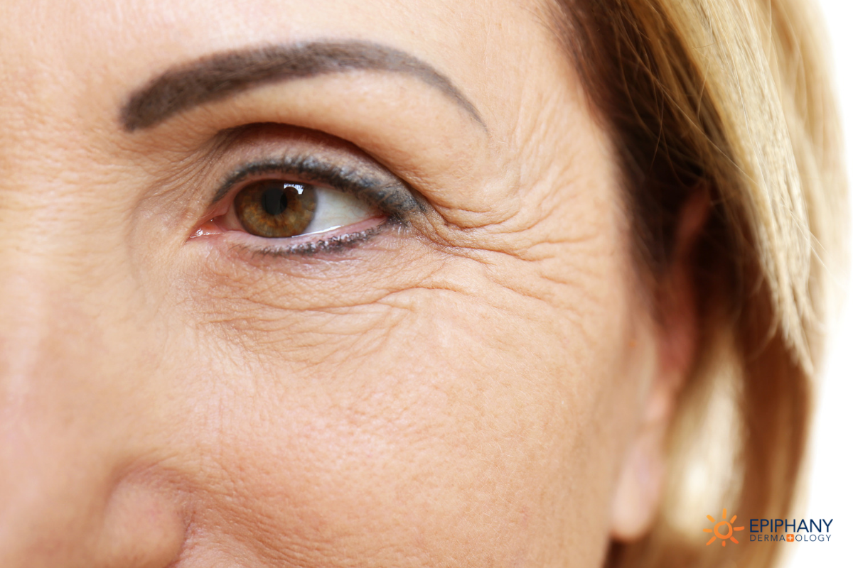Fine Lines & Wrinkles