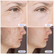 Hydra Pen H3 Microneedling Pen